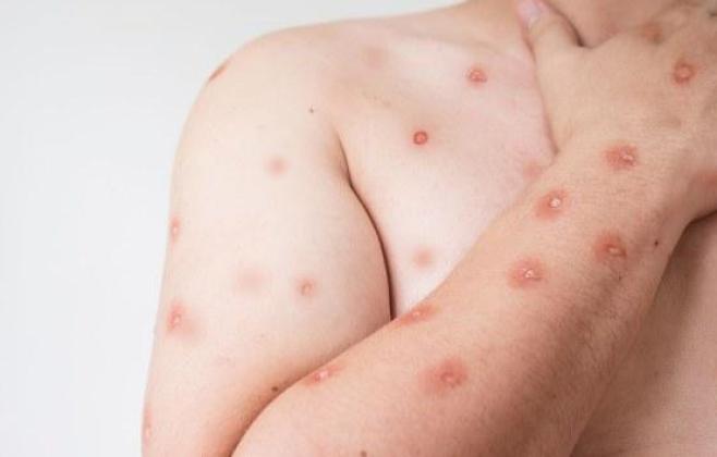 ses-alerta-para-monitoramento-de-casos-de-mpox-em-mt-apos-avanco-de-variante-em-rondonia
